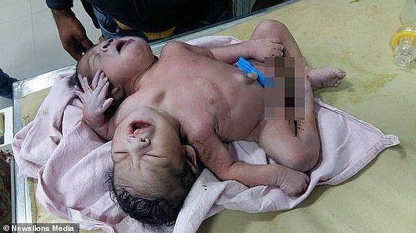2017 yılında da Hindistan'da yapışık ikiz vakası görülmüştü ancak bebek doğduktan 24 sonra vefat etmişti.