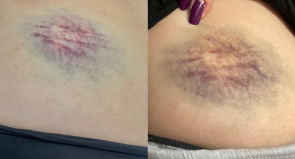 Eski Ülkü Ocakları Başkanından Kadına Şiddet: Bayıltana Kadar Dövdü, Serbest Kaldı