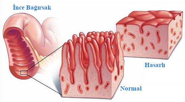 Çölyak, vücudun glutene karşı anormal bir tepki gösterdiği bir otoimmün hastalığıdır.