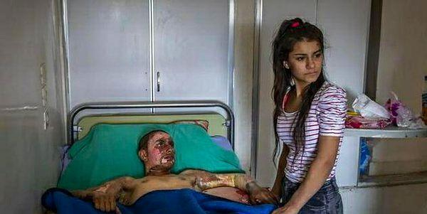 4. Suriye'deki savaşta yüzü yanan bir çocuk ve korkusundan sevgilisinin yüzüne bakamayan bir kadın: