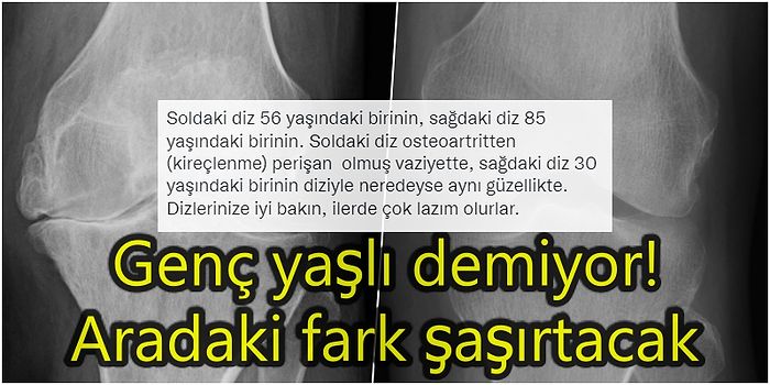 Gençliğinize Güvenmeyin, Dizlerinize İyi Bakın! Doktordan Uyarı: Sağlığınızı Korumak İçin Neler Önemli?