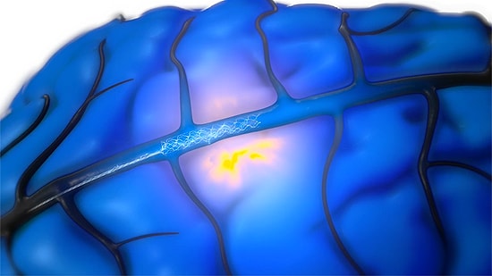 İnsan Beynine Çip Takma Denemeleri Başladı