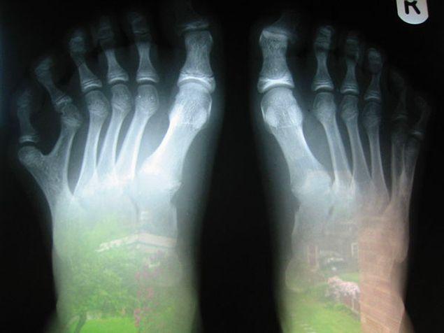8. "Kardeşim 12 ayak parmağı ile doğdu. İşte röntgeni.”
