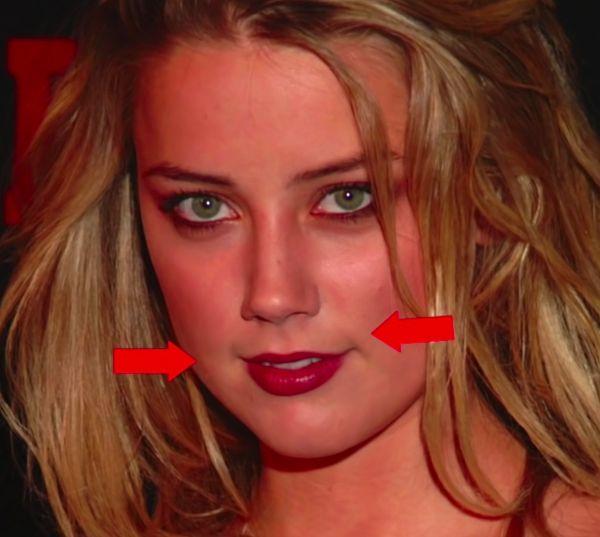 1. İlk olarak dudakları ile başlayalım. Amber Heard'ün daha ince olan üst dudağı için tercih ettiği operasyona 'V to Y Lip Augmentation' deniyor.