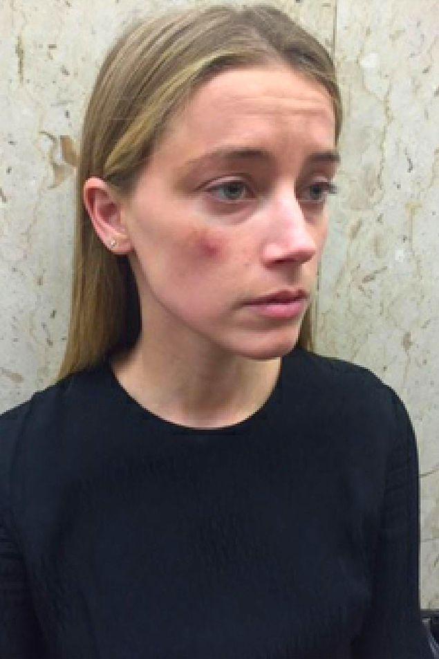 Depp bu iddiaları kabul etmese de Amber Heard mahkemeye bazı fotoğraflar sunmuştu.