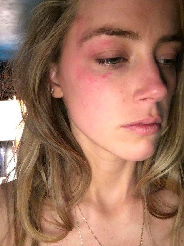 Kandırıldık! Amber Heard'ün Mahkemeye Sunduğu Yüzünde Morluklar Olan Fotoğrafının Gerçek Olmadığı Ortaya Çıktı