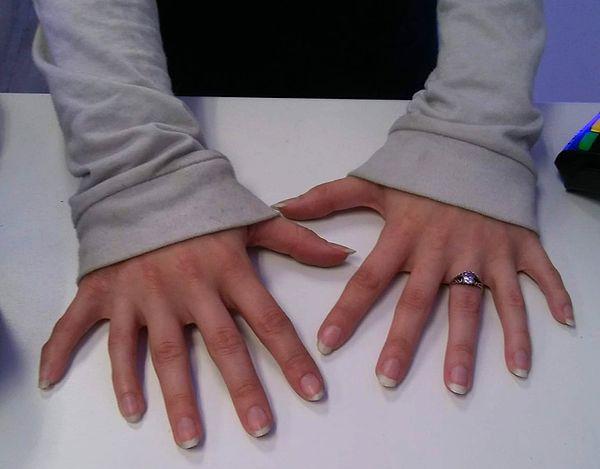 1. 6 Parmağa sahip olmak aslında baskın bir özelliktir, ancak bu genler nadirdir.