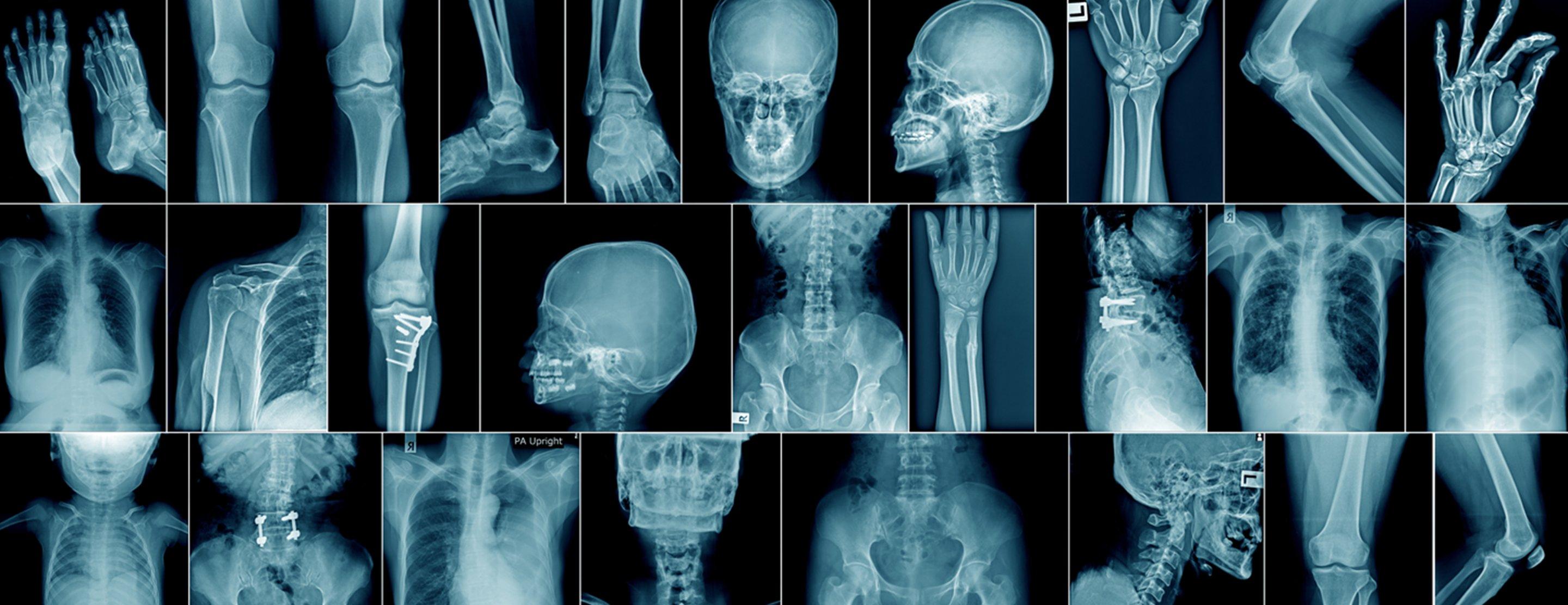 Bilim İnsanları Şokta: Yapay Zeka Kendi Kendine Röntgenlerden Irkları Tahmin Etmeye Başladı