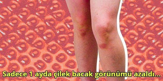 Yaz Aylarının Kabusu Olan Keratosis Pilaris, Yani Çilek Bacak Probleminden Nasıl Kurtuldum?