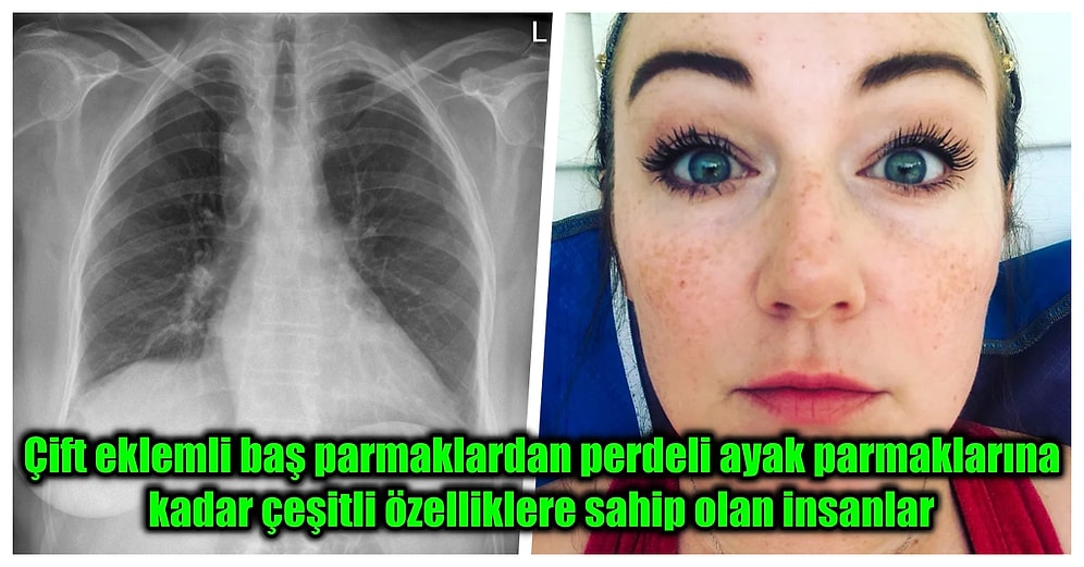 Dünyada Sadece Çok Az Kişide Rastlanan ve Görünce Afallamanıza Sebep Olacak Sıra Dışı Vücut Özellikleri