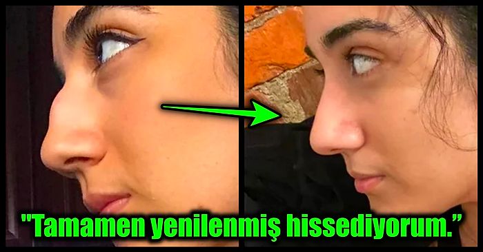 Estetik Ameliyatlarından Sonra Adeta Yeniden Doğan İnsanların Fotoğrafları