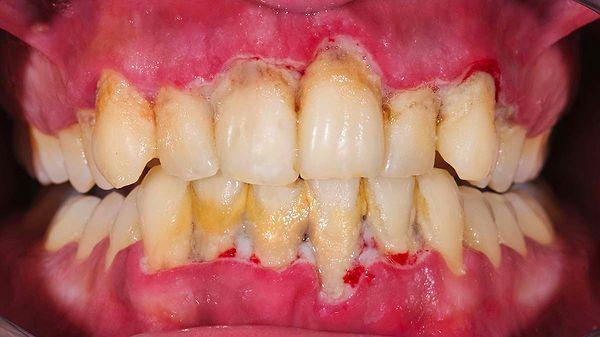 11. Diş sağlığını olumsuz etkiler.