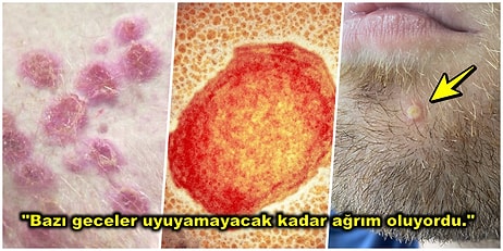 Maymun Çiçeği Virüsü Kapan Genç Adam Hastalık Sürecini ve Başından Geçenleri Tek Tek Anlattı!