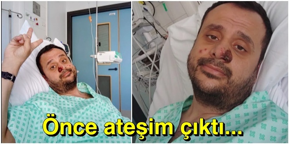 Maymun Çiçeği (Monkey Pox) Virüsüne Yakalanan Harun Hastalıkla İlgili Detayları ve Görüntüsünü Paylaştı