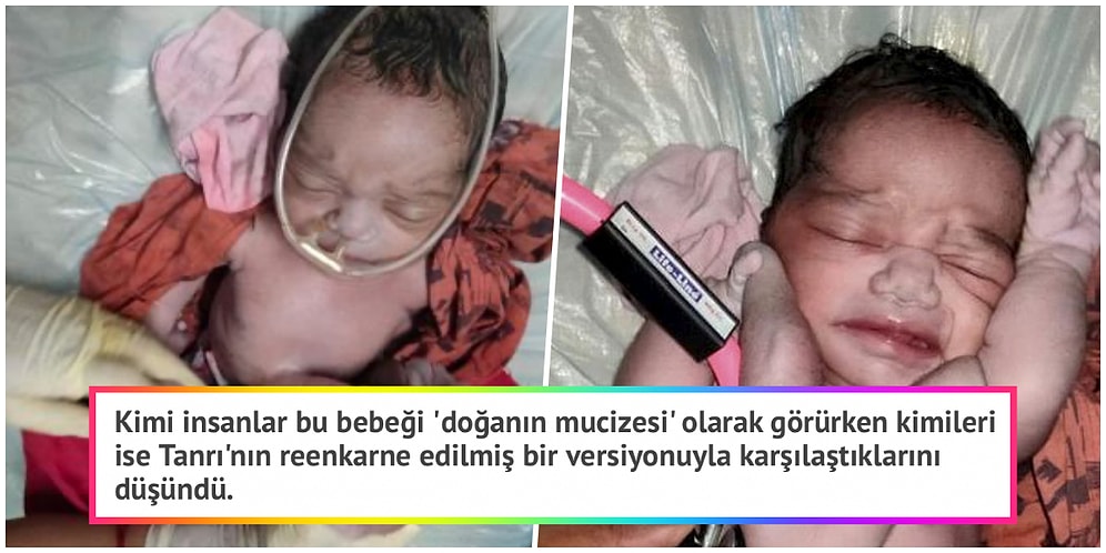 Hindistan Halkına Tanrı'nın Dünya'ya Geldiğini Düşündürten Dört Kollu ve Dört Bacaklı Doğan Bebek