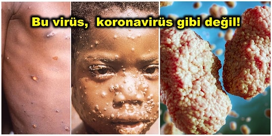 Yeni Bir Salgına Dönmesinden Korkulan Maymun Çiçeği Virüsü Hakkında Bilmeniz Gereken Her Şey!