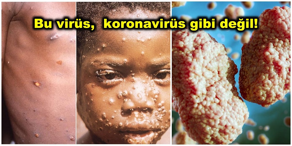 Yeni Bir Salgına Dönmesinden Korkulan Maymun Çiçeği Virüsü Hakkında Bilmeniz Gereken Her Şey!