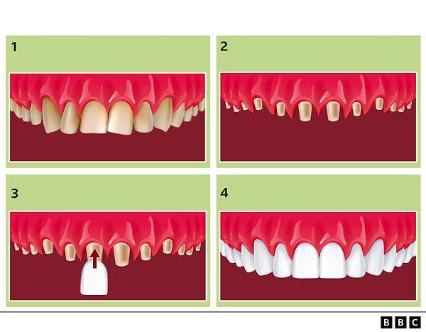 Liverpool'daki bir diş kliniğinin müdürü olan Dr. MJ Rowland-Warmann ise kronların büyük komplikasyonlara neden olabileceğini vurguladı.