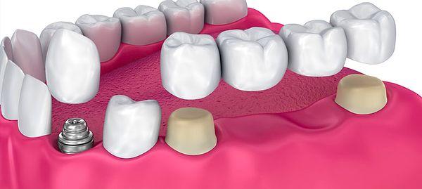 Kron tedavisinde bir diş kapağı üste yapıştırılmadan önce doğal dişin %60 - %70'inin dişlere veya saplara kadar törpülenmesini içerir.