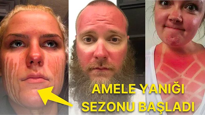 Bahtsız Bedeviliğin Kitabını Baştan Yazarak Görenleri Haline Şükrettiren Güneş Yanıklarına Sahip 18 Kişi