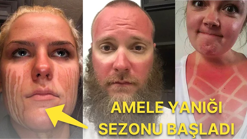 Bahtsız Bedeviliğin Kitabını Baştan Yazarak Görenleri Haline Şükrettiren Güneş Yanıklarına Sahip 18 Kişi
