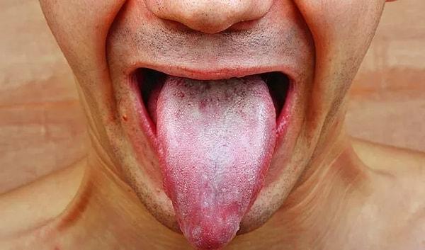 3. Dildeki beyaz bölgeler