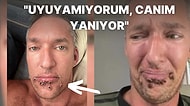 "Monkeypox" Yani Maymun Çiçeği Virüsü Bulaşan Adam Kabusa Dönen Hayatını ve Acı Dolu Etkilerini Anlattı!