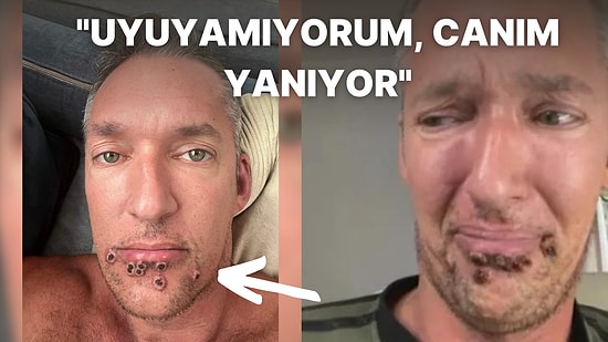 "Monkeypox" Yani Maymun Çiçeği Virüsü Bulaşan Adam Kabusa Dönen Hayatını ve Acı Dolu Etkilerini Anlattı!