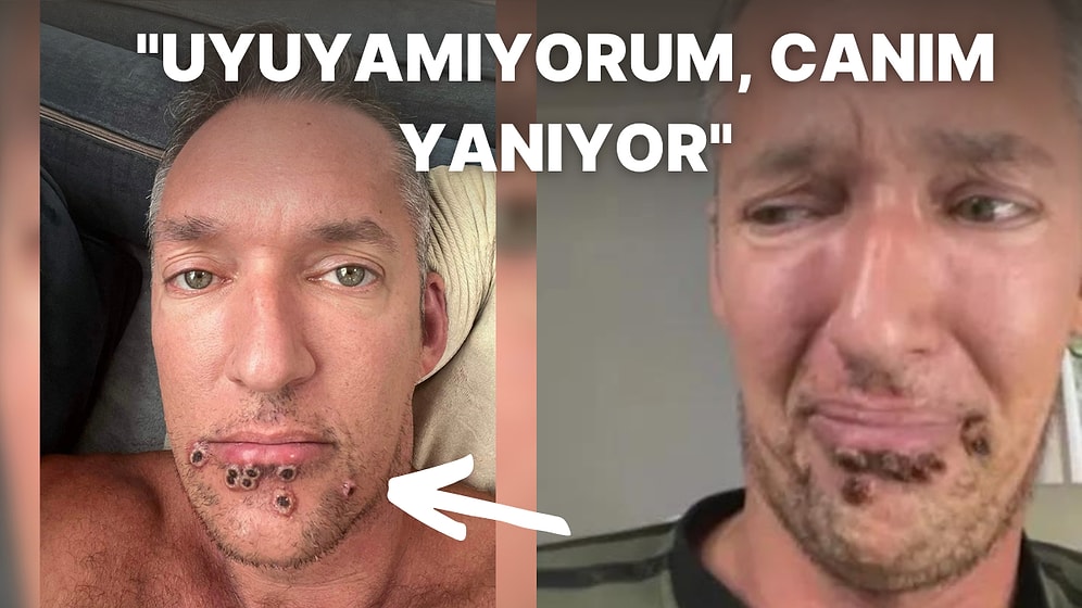 "Monkeypox" Yani Maymun Çiçeği Virüsü Bulaşan Adam Kabusa Dönen Hayatını ve Acı Dolu Etkilerini Anlattı!