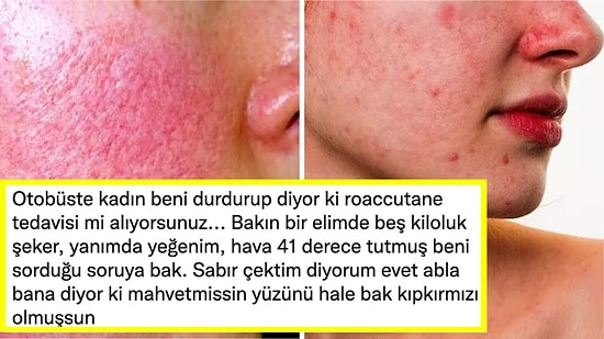 Gül Hastalığı Olduğu İçin İlaç Kullanan Gencin Otobüste Maruz Kaldığı Hadsiz Yorum Sinirlerinizi Bozacak