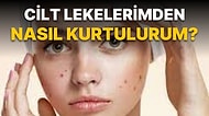 Cilt Lekelerine Çok İyi Geldiği Söylenen Gece Losyonları