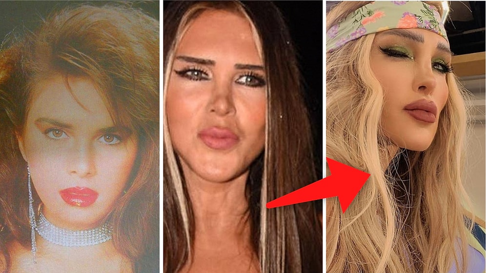 Yeni Doğan Bebeğin Sünnet Derisini Yüzüne Uygulatmış! Değişime Doyamayan Seren Serengil'in Estetik Yolculuğu