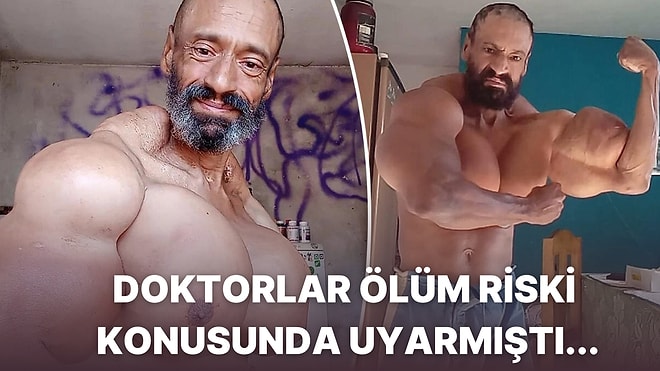 Dünyaya Adını 'Brezilyalı Hulk' Olarak Duyuran Adam Kaslarına Yaptığı Enjeksiyon Sebebiyle Hayatını Kaybetti