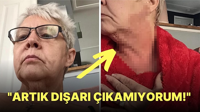 Yine Bir Estetik Faciası! Boynundaki Sarkık Deriden Kurtulmak İsterken 'Yaşlı Tavuğa' Benzeyen Bahtsız Kadın