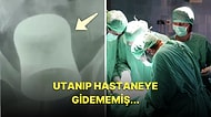 Anüsünden Sokmuş! Mide Ağrısı ile Hastaneye Giden Adamın İçinden Çıkartılan Cisim Tüm Doktorları Şaşırttı