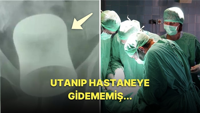 Anüsünden Sokmuş! Mide Ağrısı ile Hastaneye Giden Adamın İçinden Çıkartılan Cisim Tüm Doktorları Şaşırttı