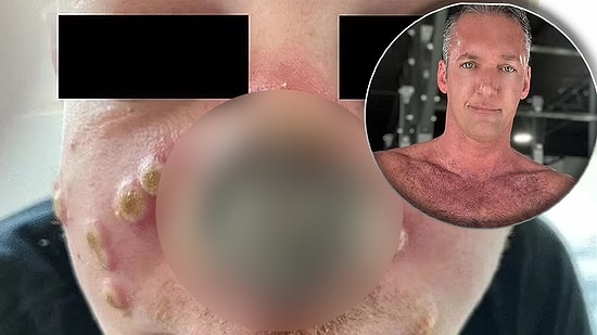 Maymun Çiçeği Hastalığına Yakalandı: Nokta Gibi Çıktı, 3 Günde Burnu Çürüdü!