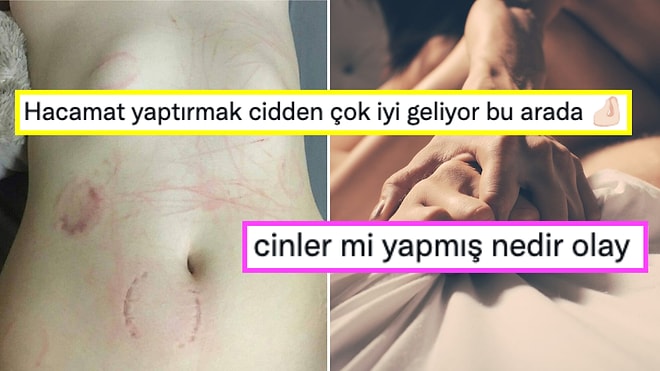 Hızını Alamayıp Cinsel İlişki Sonrası Vücudunun Isırık Dolu Fotoğrafını Paylaşan Kullanıcıya Gelen Yorumlar