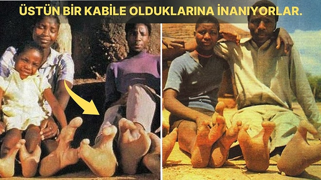 Değişik Görüntüleri Nedeniyle Başka Bir Gezegenden Geldiğini Düşünen Devekuşu Ayağı Sendromlu Afrika Kabilesi