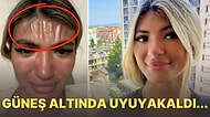 Güneşlenirken Uyuyakalan Kadının Yüzünün Geçirdiği Korkunç Deformasyonu Görünce Güneş Kreminizi Süreceksiniz!