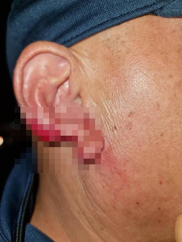 Aşırı sarhoş olduğu söylenen Taylandlı bir seks işçisi, 55 yaşındaki bir turiste saldırarak önce kulağını ısırdı; sonra ise kopardığı parçayı herkesin gözleri önünde yuttu!