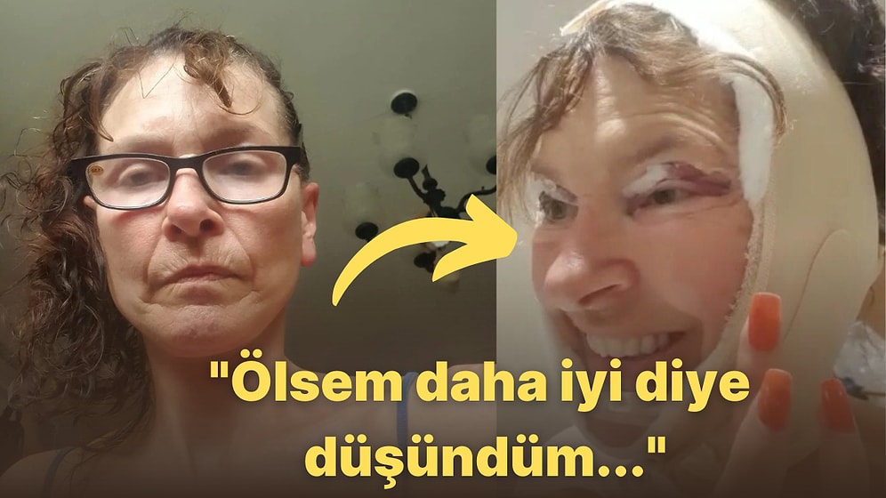 "Keşke Ölsem!" Uğruna Binlerce Sterlin Harcadığı Yüz Gerdirme İşleminden Dert Yanan Kadının Hikayesi