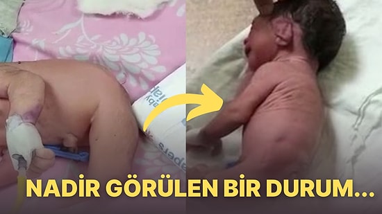 Uzun Kuyruğu Var: Bacakları Olmadan Dünyaya Gelen Bebek Doktorları Hayrete Düşürdü