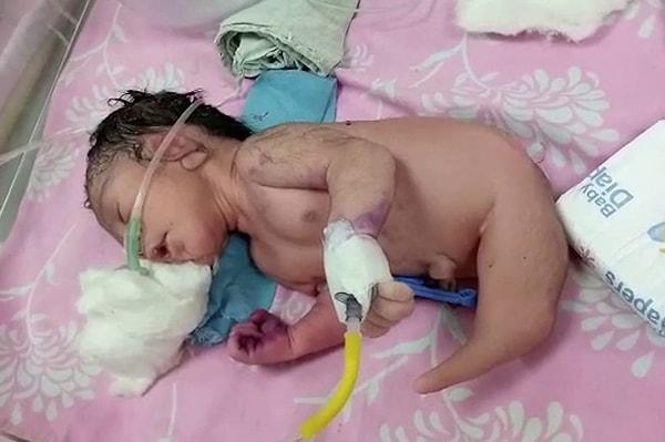 Henüz gelişmemiş olan bebek sadece 1,4 kilo ağırlığında ve Hindistan'da bir hastanede yatıyor.