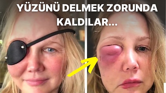 Yüzünde Delik Oluştu! Daha Genç Görünmek İsterken Neredeyse Yüzünden Olan Talihsiz Kadın