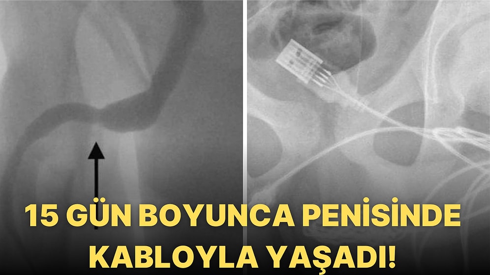 Uzunluk Ölçmek İçin Penisinin İçine USB Kablo Sokan Gencin Ameliyathanede Sonlanan Bahtsız Hikayesi