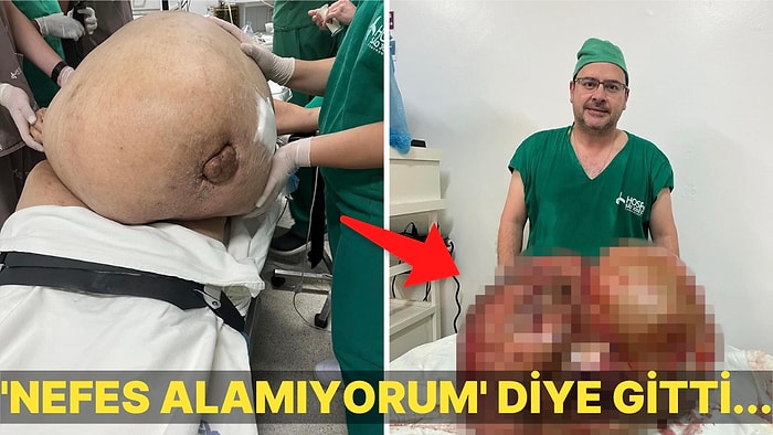 Nefes Darlığı Diye Gittiği Hastanede Acilen Ameliyata Alınarak Karnından 45 Kilogram Tümor Çıkarılan Kadın