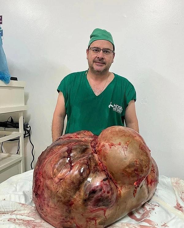 15. Nefes darlığı nedeniyle hastaneye giden adamın karnından 45 kilo tümör çıkartıldı.