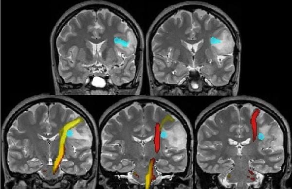 6. fMRI tekniğinde çeşitli görseller gösterilerek ve müzikler dinletilerek beynin içindeki kan akışı izlenilerek beynin gerçekte nasıl tepki verdiği bulunur.