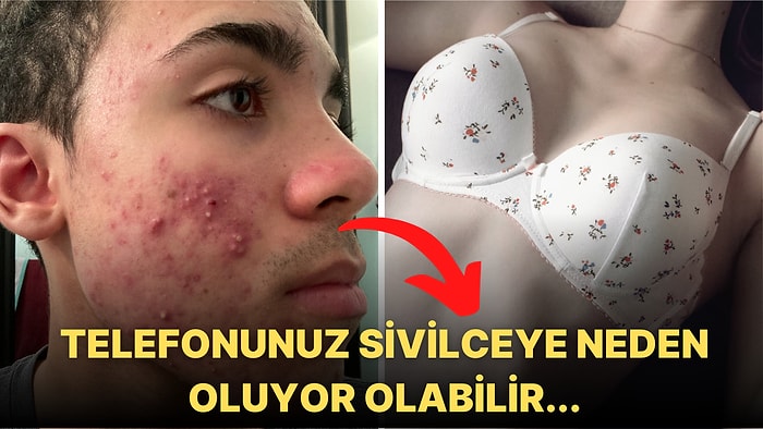 Vücudunuzun Farklı Bölgelerinde Çıkan Sivilceler Alışkanlıklarınız Hakkında Neler Söylüyor?